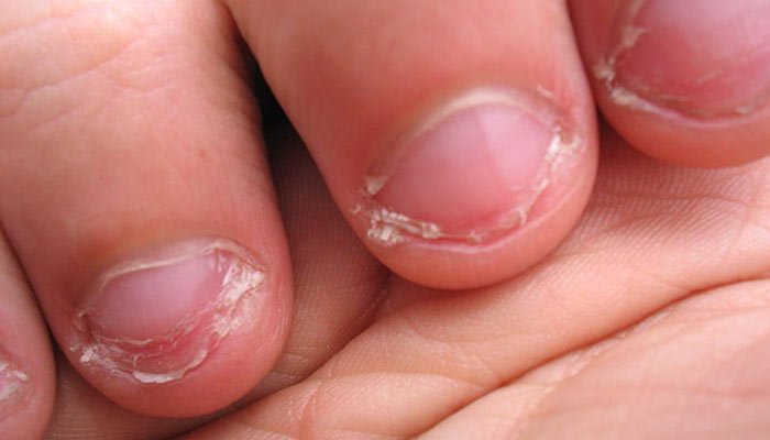 10 remedios naturales para prevenir el morderse las uñas